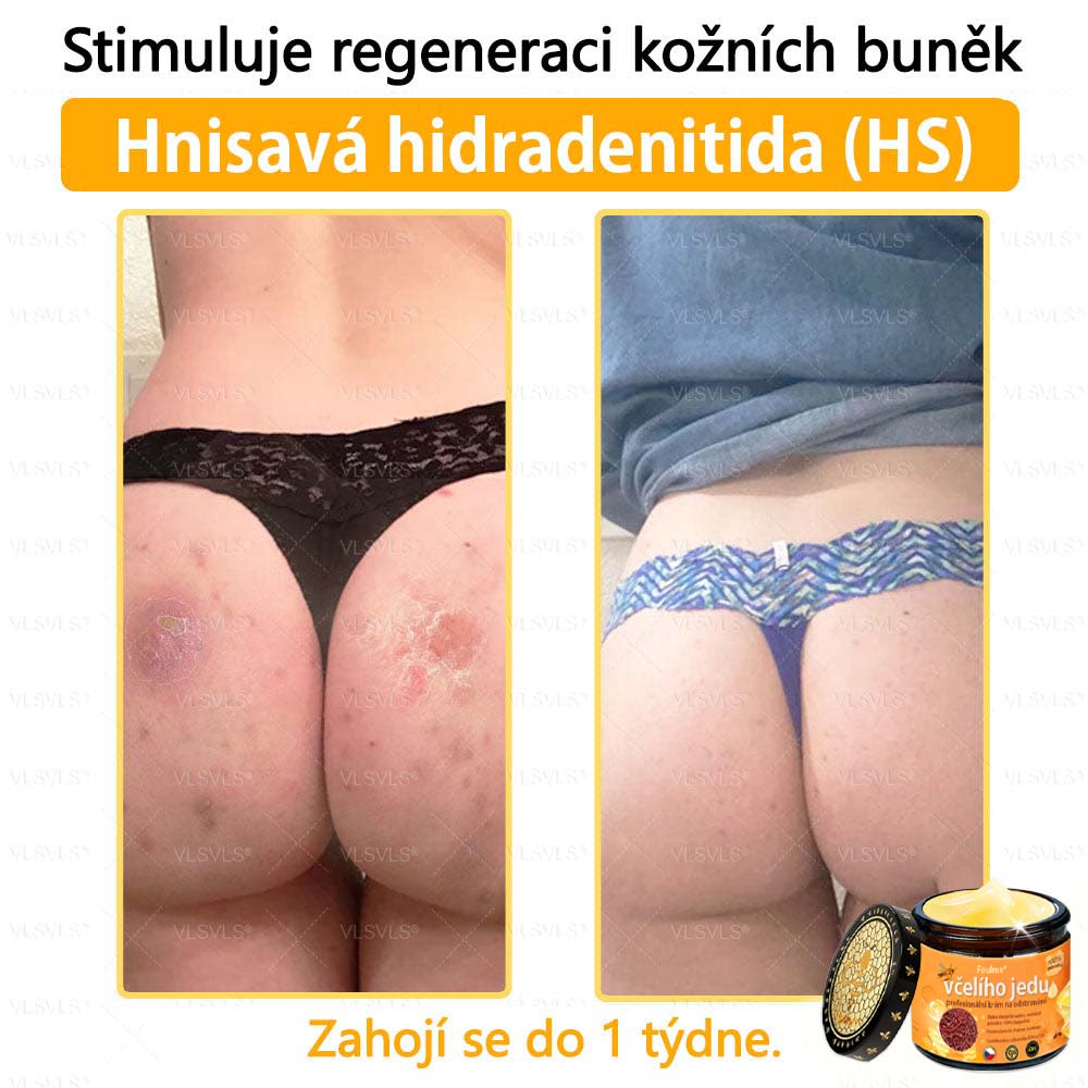 Foulme® Profesionální krém na odstranění včelího jedu🐝