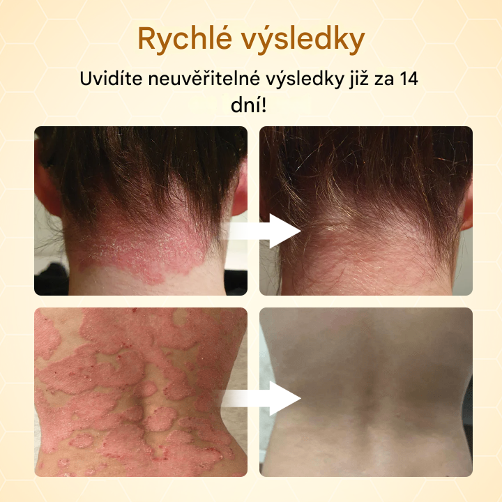 Timilk® BeeLieve Péče o pokožku s lupénkou