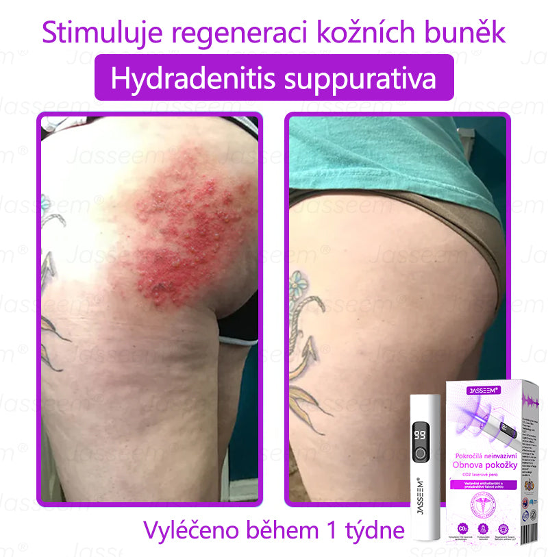 𝐉𝐚𝐬𝐬𝐞𝐞𝐦® Pokročilé neinvazivní pero s CO₂ laserem na opravu pokožky 💕 (šetrně odstraňuje bradavice, mateřská znaménka, stařecké skvrny a kožní značky - bez bolesti a rozruchu!)