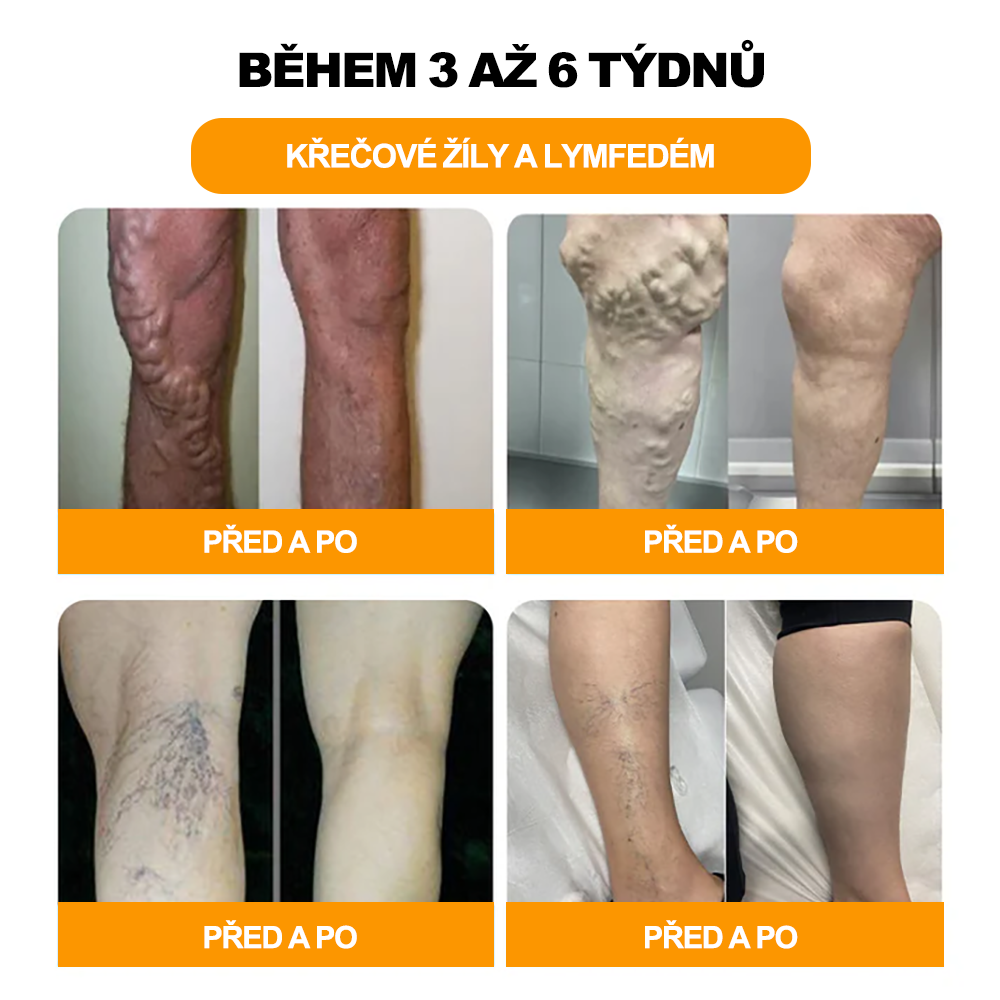 🔥💫 Poslední den na získání slevy 70 %: Aeehfeng® Včelí jed a 30 bylinek pro detoxikaci nohou a korálky pro tvarování těla - ✨Doporučeno Evropskou lymfatickou asociací (ELF) ✨🧀