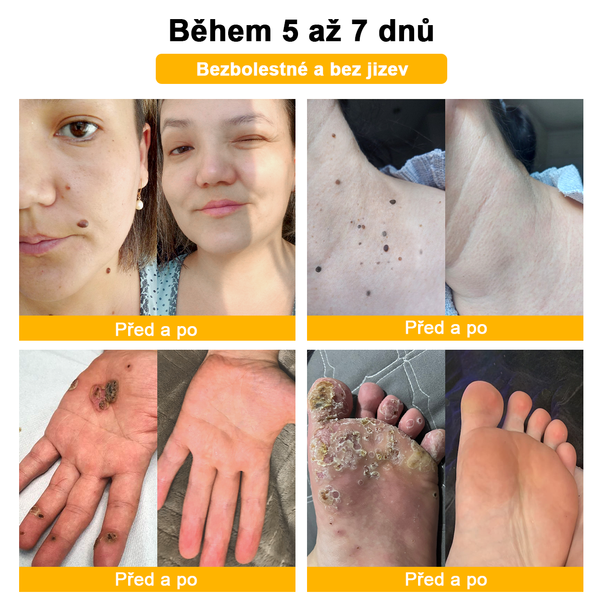 🌱🌠✨AEXZR™ Krém proti bradavicím a krtkům se včelím jedem