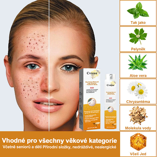 💗Sprej na odstranění bradavic a pásového oparu ze včelího jedu (👨⚕AAD Doporučujeme) 🐝🐝(🔥Nabídka na poslední den se slevou 80 %)