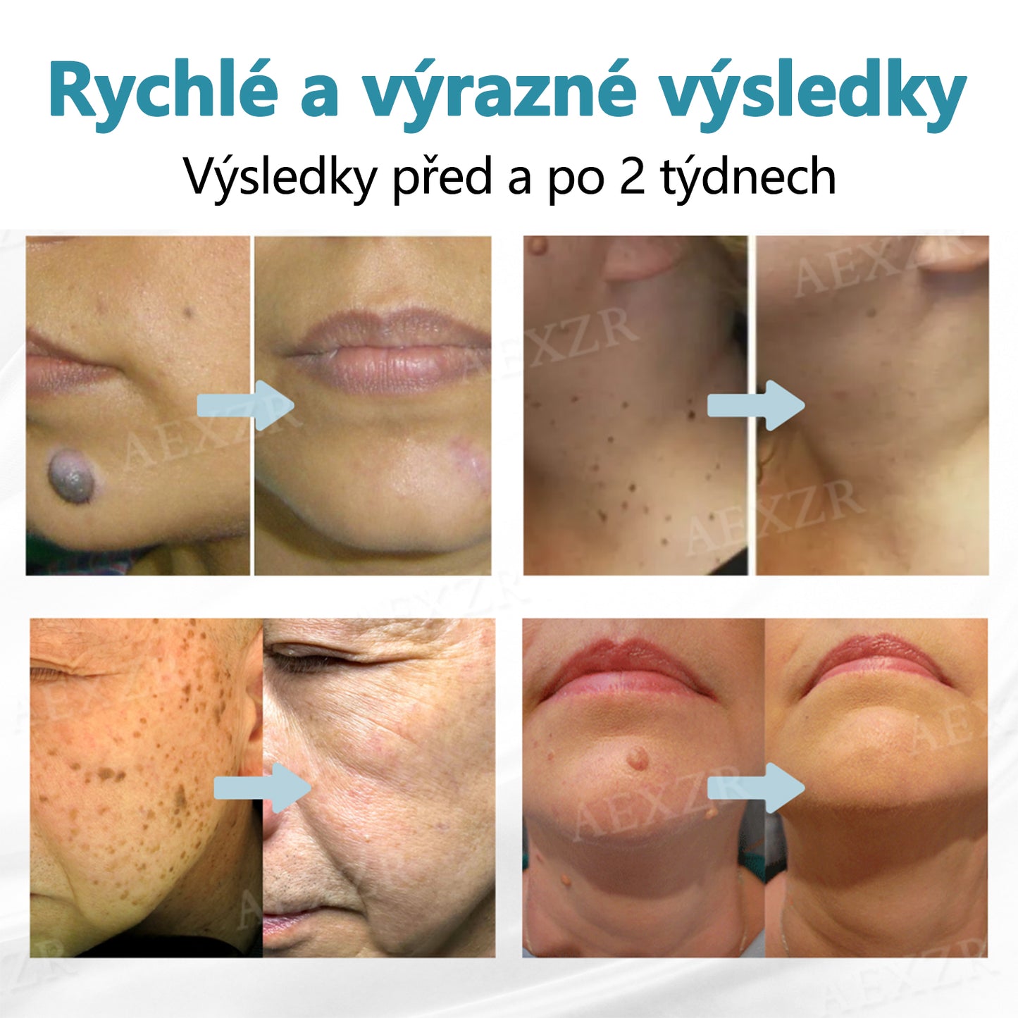 Foulme® PRO Neinvazivní laserové pero na odstraňování bradavic a znamének