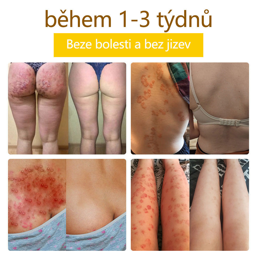✅Flysmus™ krém na ošetření včelím jedem🐝: 💥💥Léčba ekzémů, akné, stařeckých skvrn, křečových žil, prasklin na kůži, plísňových infekcí, bradavic.💥💥✅