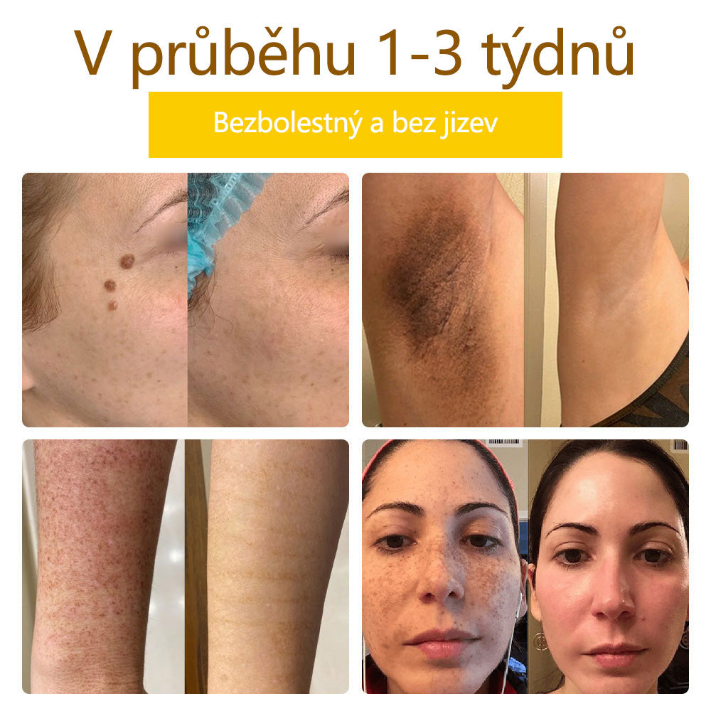 ✅Flysmus™ krém na ošetření včelím jedem🐝: 💥💥Léčba ekzémů, akné, stařeckých skvrn, křečových žil, prasklin na kůži, plísňových infekcí, bradavic.💥💥✅