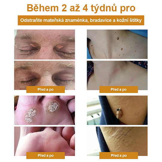 💗Sprej na odstranění bradavic a pásového oparu ze včelího jedu (👨⚕AAD Doporučujeme) 🐝🐝(🔥Nabídka na poslední den se slevou 80 %)