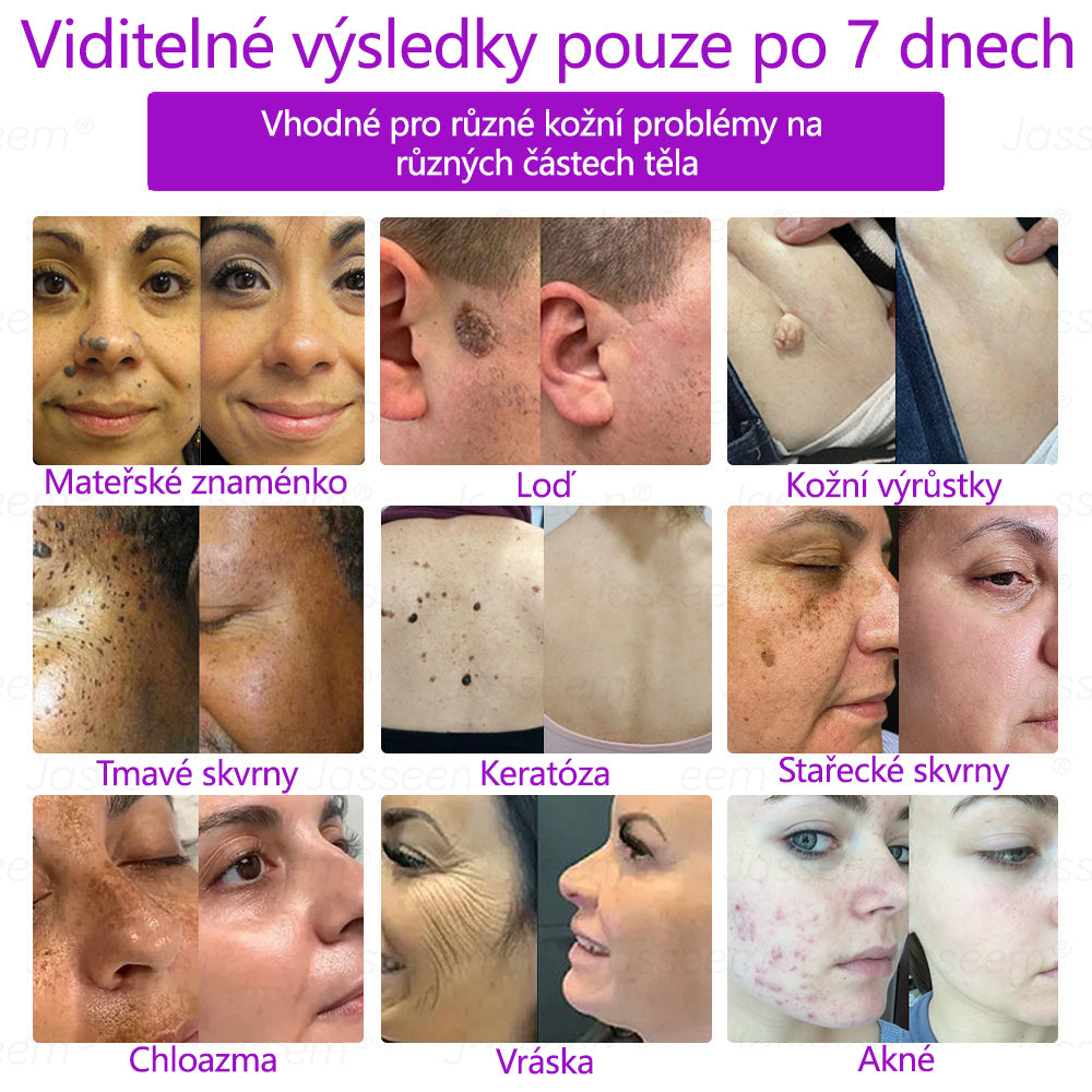 𝐉𝐚𝐬𝐬𝐞𝐞𝐦® Pokročilé neinvazivní pero s CO₂ laserem na opravu pokožky 💕 (šetrně odstraňuje bradavice, mateřská znaménka, stařecké skvrny a kožní značky - bez bolesti a rozruchu!)