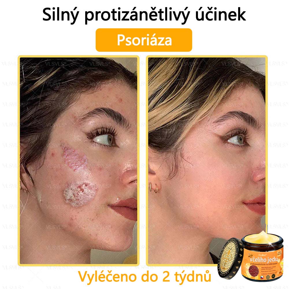 Foulme® Profesionální krém na odstranění včelího jedu🐝