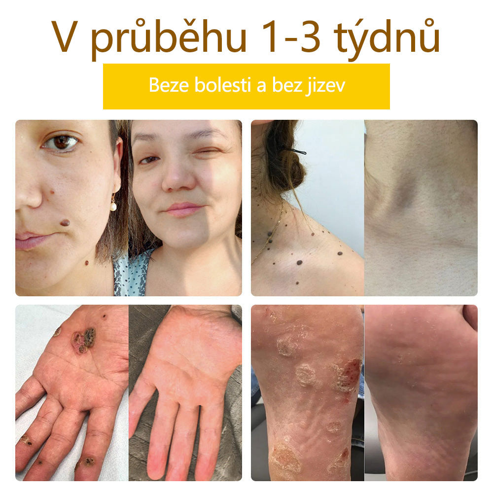 ✅Flysmus™ krém na ošetření včelím jedem🐝: 💥💥Léčba ekzémů, akné, stařeckých skvrn, křečových žil, prasklin na kůži, plísňových infekcí, bradavic.💥💥✅