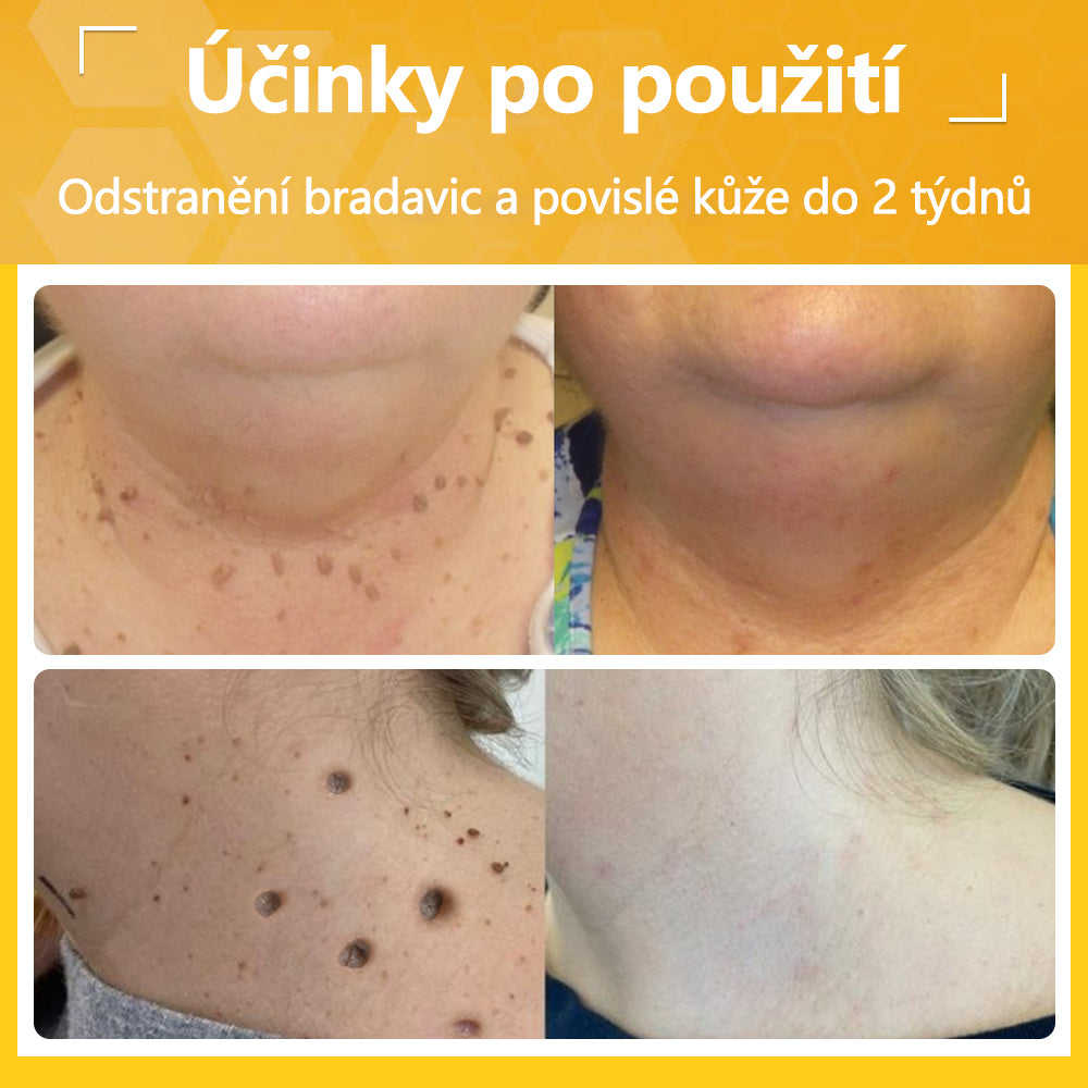 ✅flysmus® Silný krém se včelím jedem - Doporučeno dermatologickými odborníky. Účinný proti bradavicím, boulím, lézím, infekcím a jizvám.🐝