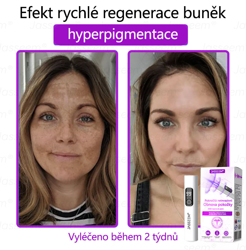 𝐉𝐚𝐬𝐬𝐞𝐞𝐦® Pokročilé neinvazivní pero s CO₂ laserem na opravu pokožky 💕 (šetrně odstraňuje bradavice, mateřská znaménka, stařecké skvrny a kožní značky - bez bolesti a rozruchu!)