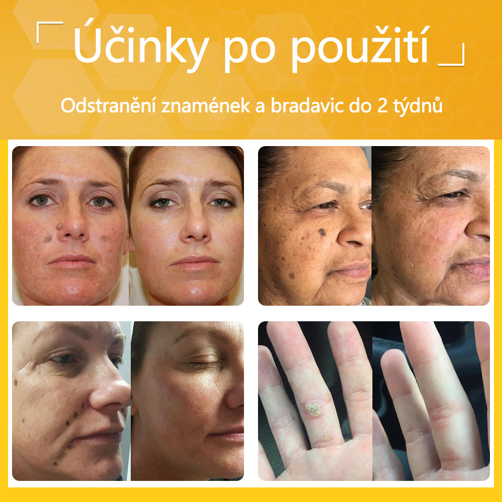 ✅flysmus® Silný krém se včelím jedem - Doporučeno dermatologickými odborníky. Účinný proti bradavicím, boulím, lézím, infekcím a jizvám.🐝