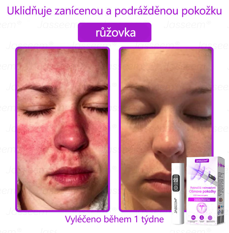 𝐉𝐚𝐬𝐬𝐞𝐞𝐦® Pokročilé neinvazivní pero s CO₂ laserem na opravu pokožky 💕 (šetrně odstraňuje bradavice, mateřská znaménka, stařecké skvrny a kožní značky - bez bolesti a rozruchu!)