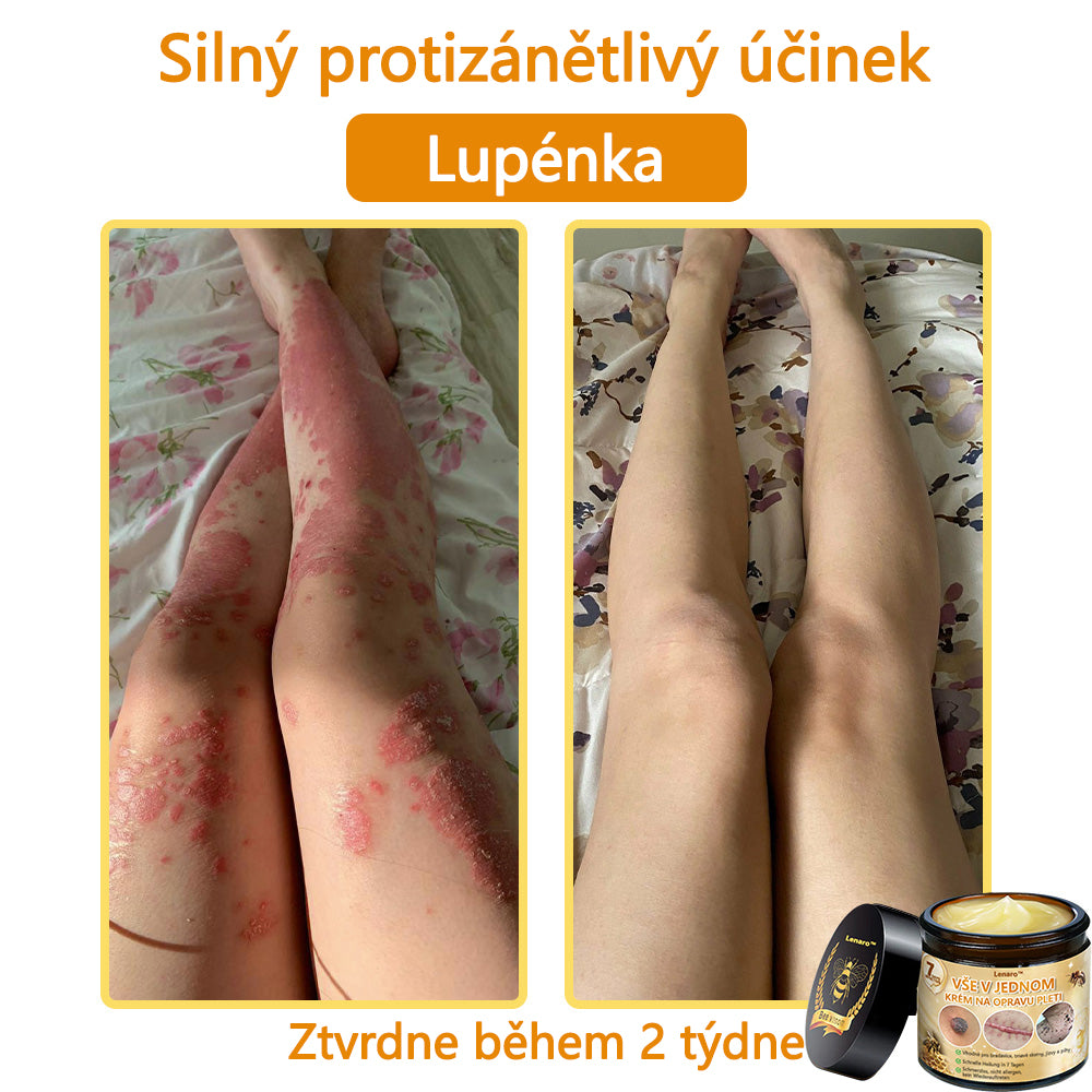 【Oficiální značkový obchod】🎇𝐋𝐞𝐧𝐚𝐫𝐨™ Včelí jed všestranný krém, schválený českými dermatology (👩 Doporučeno Českou společností pro kožní a pohlavní nemoci CGDV)💥