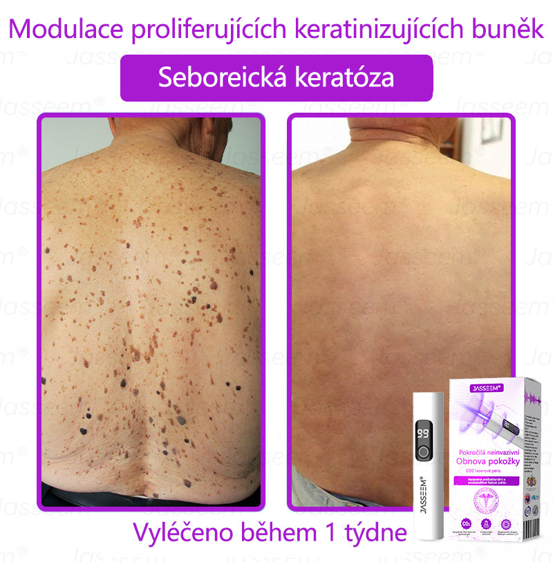 𝐉𝐚𝐬𝐬𝐞𝐞𝐦® Pokročilé neinvazivní pero s CO₂ laserem na opravu pokožky 💕 (šetrně odstraňuje bradavice, mateřská znaménka, stařecké skvrny a kožní značky - bez bolesti a rozruchu!)