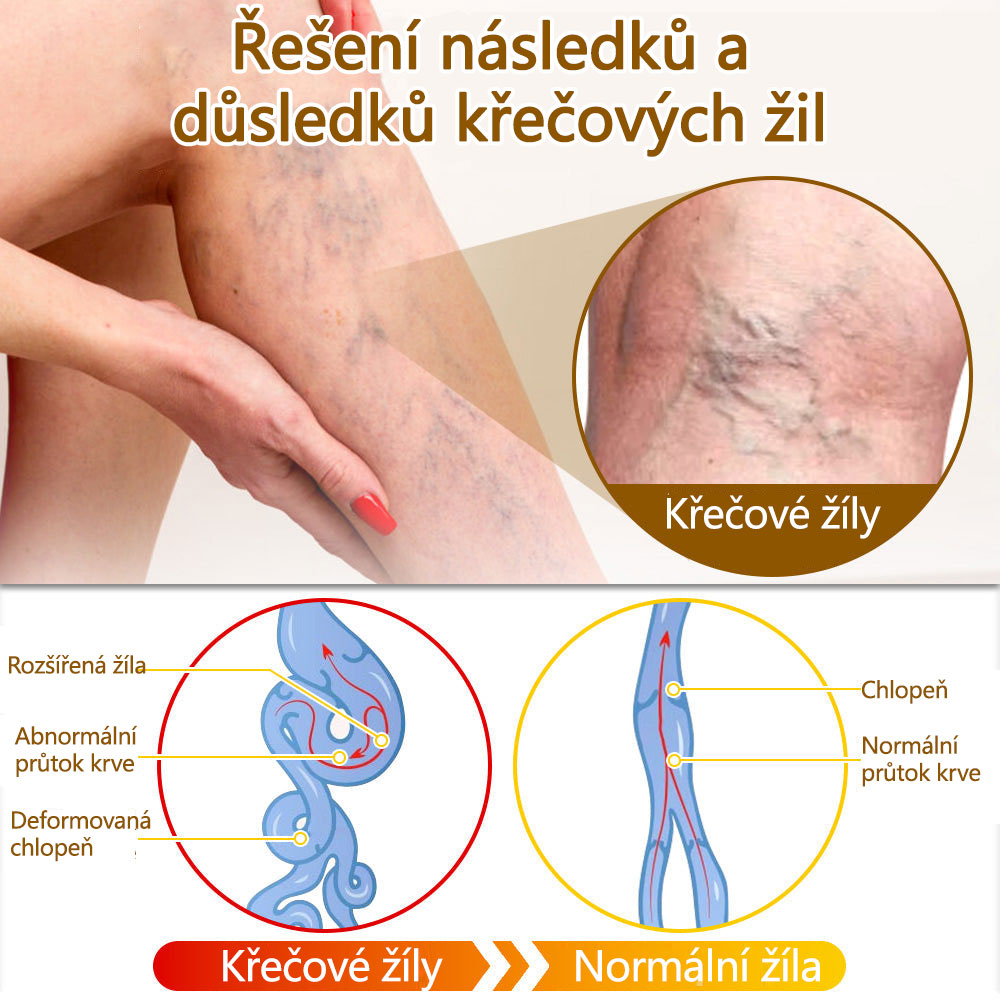 ✅Flysmus™ krém na ošetření včelím jedem🐝: 💥💥Léčba ekzémů, akné, stařeckých skvrn, křečových žil, prasklin na kůži, plísňových infekcí, bradavic.💥💥✅
