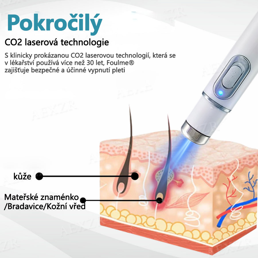 Foulme® PRO Neinvazivní laserové pero na odstraňování bradavic a znamének