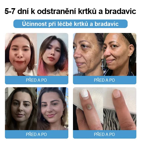 💗Sprej na odstranění bradavic a pásového oparu ze včelího jedu (👨⚕AAD Doporučujeme) 🐝🐝(🔥Nabídka na poslední den se slevou 80 %)