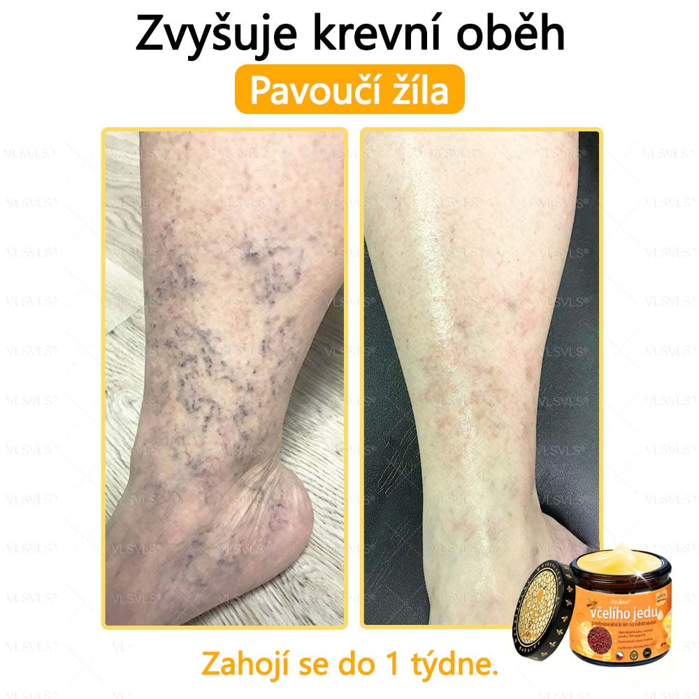 Foulme® Profesionální krém na odstranění včelího jedu🐝