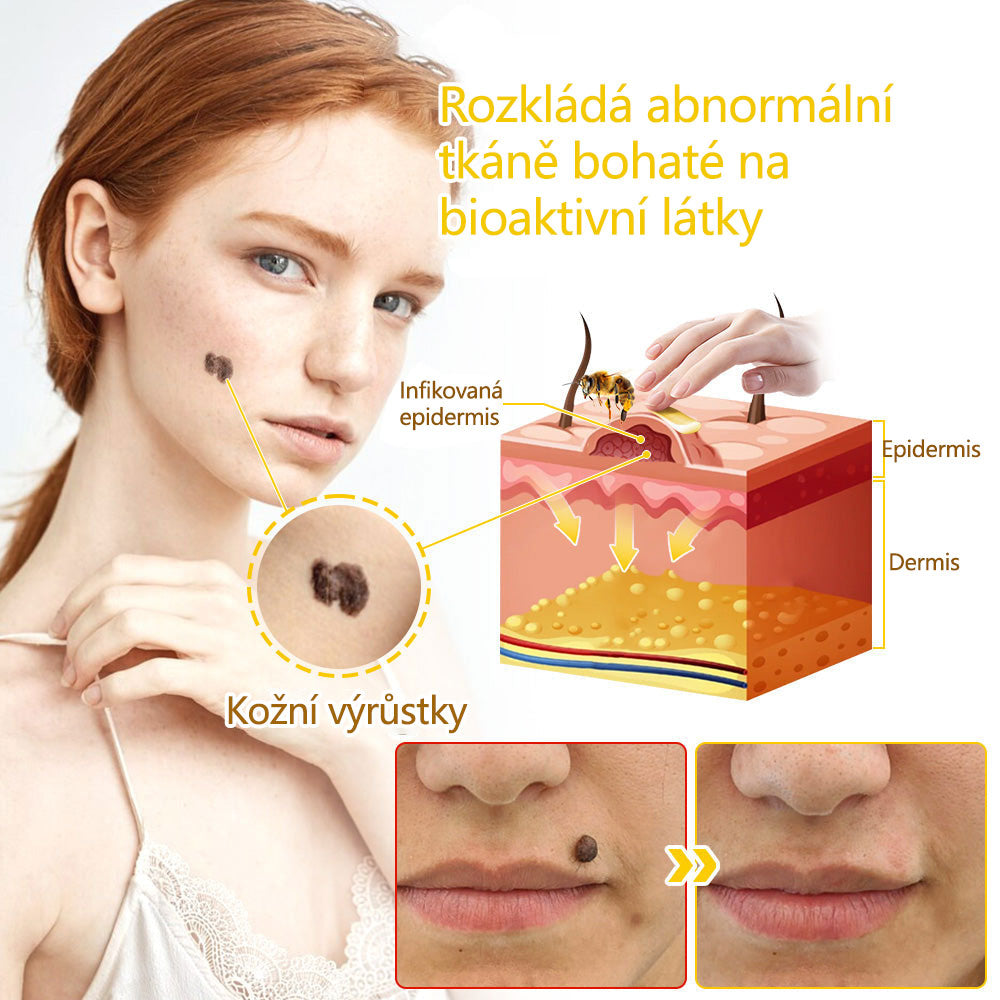 ✅Flysmus™ krém na ošetření včelím jedem🐝: 💥💥Léčba ekzémů, akné, stařeckých skvrn, křečových žil, prasklin na kůži, plísňových infekcí, bradavic.💥💥✅