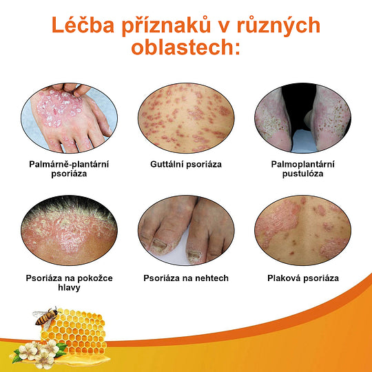 💗Sprej na odstranění bradavic a pásového oparu ze včelího jedu (👨⚕AAD Doporučujeme) 🐝🐝(🔥Nabídka na poslední den se slevou 80 %)