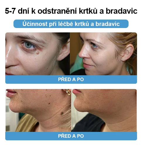 💗Sprej na odstranění bradavic a pásového oparu ze včelího jedu (👨⚕AAD Doporučujeme) 🐝🐝(🔥Nabídka na poslední den se slevou 80 %)