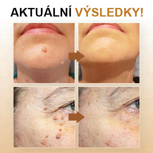 💗Sprej na odstranění bradavic a pásového oparu ze včelího jedu (👨⚕AAD Doporučujeme) 🐝🐝(🔥Nabídka na poslední den se slevou 80 %)