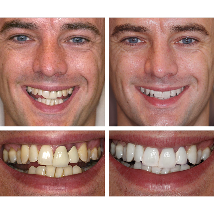 ⏳Časově omezená nabídka⏳LIMETOW™ Teeth Whitening Essence