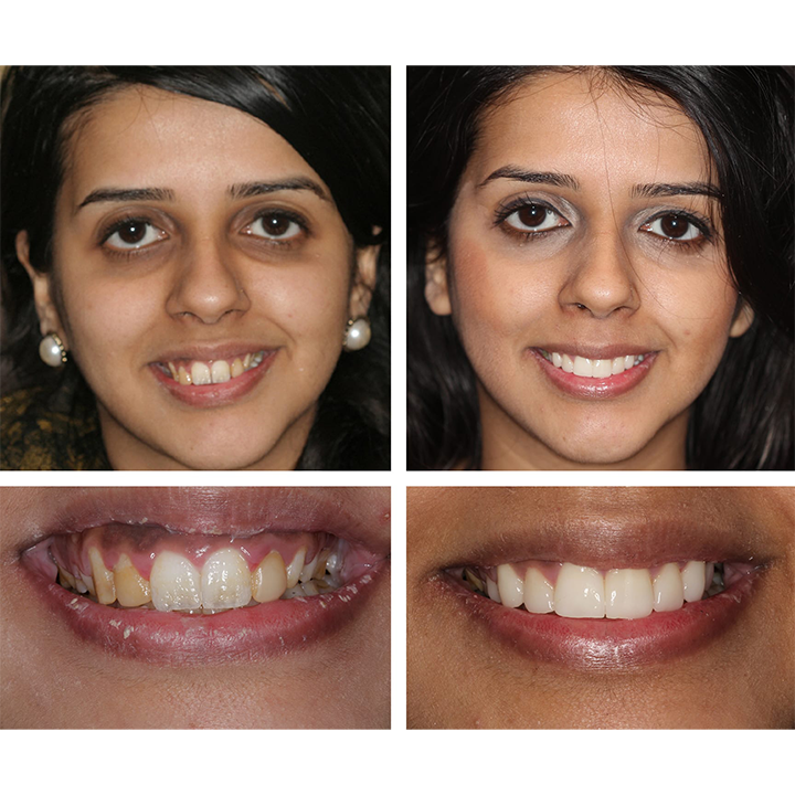 ⏳Časově omezená nabídka⏳LIMETOW™ Teeth Whitening Essence