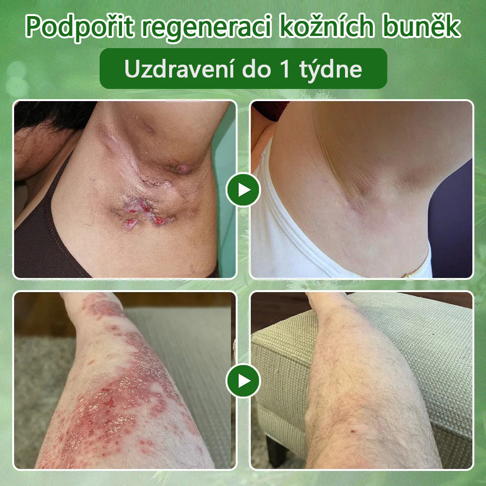 🌱 Zvoevo® Čajovníkový olej Krém pro péči o pleť – Odstraňuje nedokonalosti pleti, regeneruje poškozenou pokožku, rozjasňuje a působí proti stárnutí pleti.🔥🔥