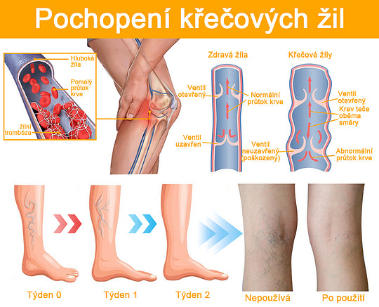 【✨Dobírka✨】Sprej na křečové žíly Furzero™ Bee Venom🐝🐝🐝