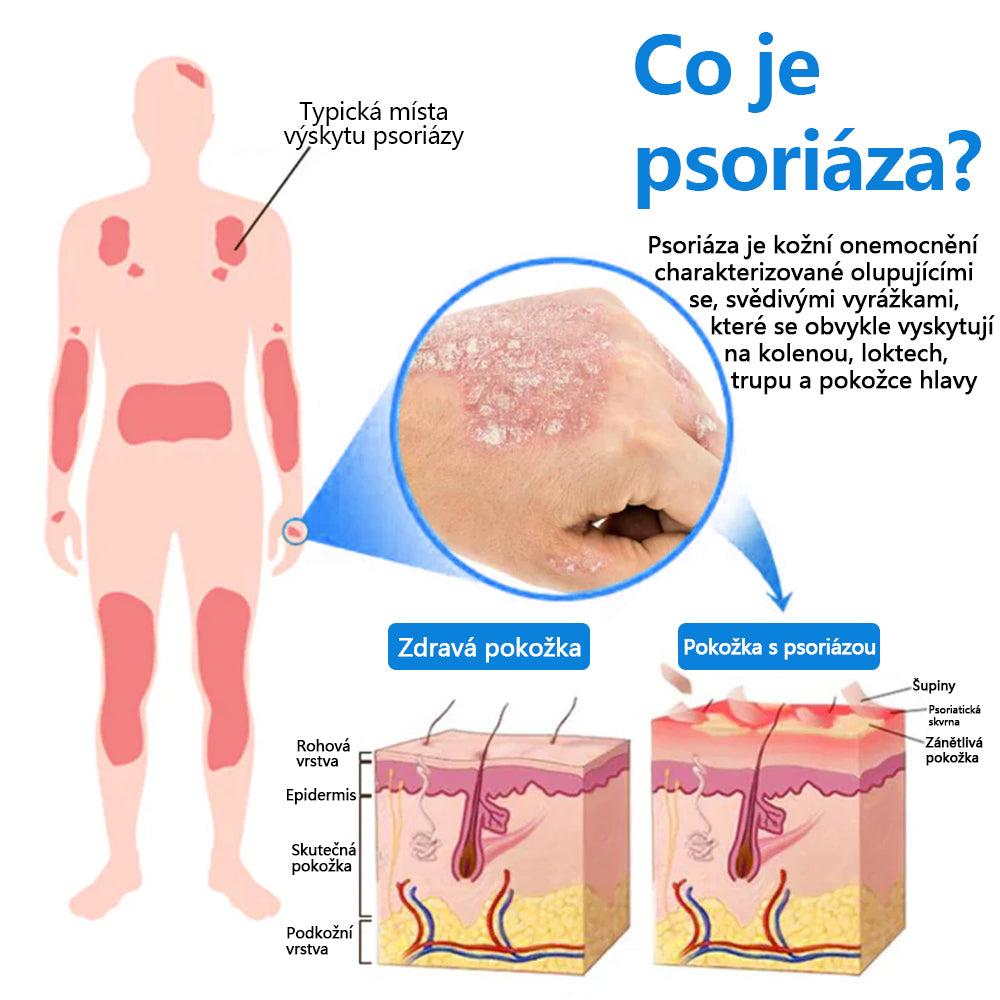 ✅Zvoevo® Magnesium bylinný sprej ⚕️ Certifikace MHRA – úleva při psoriáze, ekzému, intimních bakteriálních infekcích, akné a tmavých skvrnách