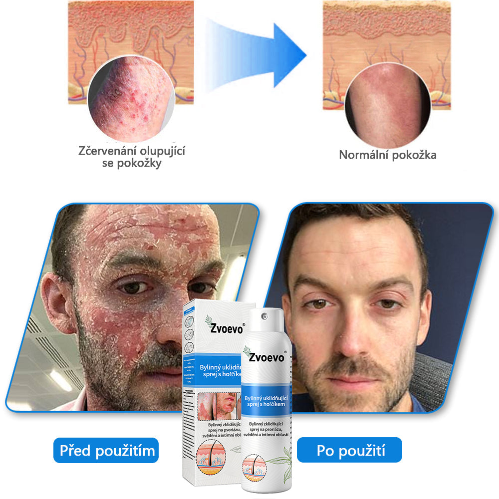 ✅Zvoevo® Magnesium bylinný sprej ⚕️ Certifikace MHRA – úleva při psoriáze, ekzému, intimních bakteriálních infekcích, akné a tmavých skvrnách