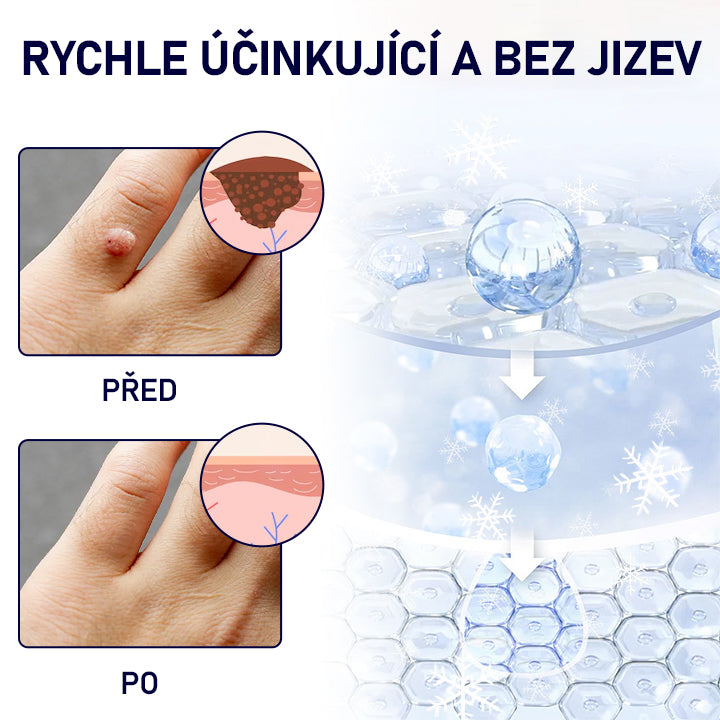 Lékárna Na Poště | Timilk® WartErase Kryogenní sprej✨