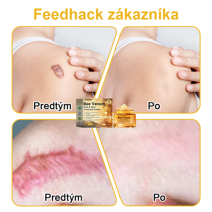 ✨🎁FROPUN krém na odstránenie znamienok a materských znamienok (posledný deň akcie 85% zľava)