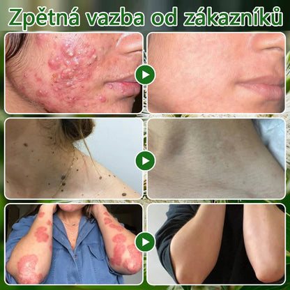 🌱 Zvoevo® Čajovníkový olej Krém pro péči o pleť – Odstraňuje nedokonalosti pleti, regeneruje poškozenou pokožku, rozjasňuje a působí proti stárnutí pleti.🔥🔥