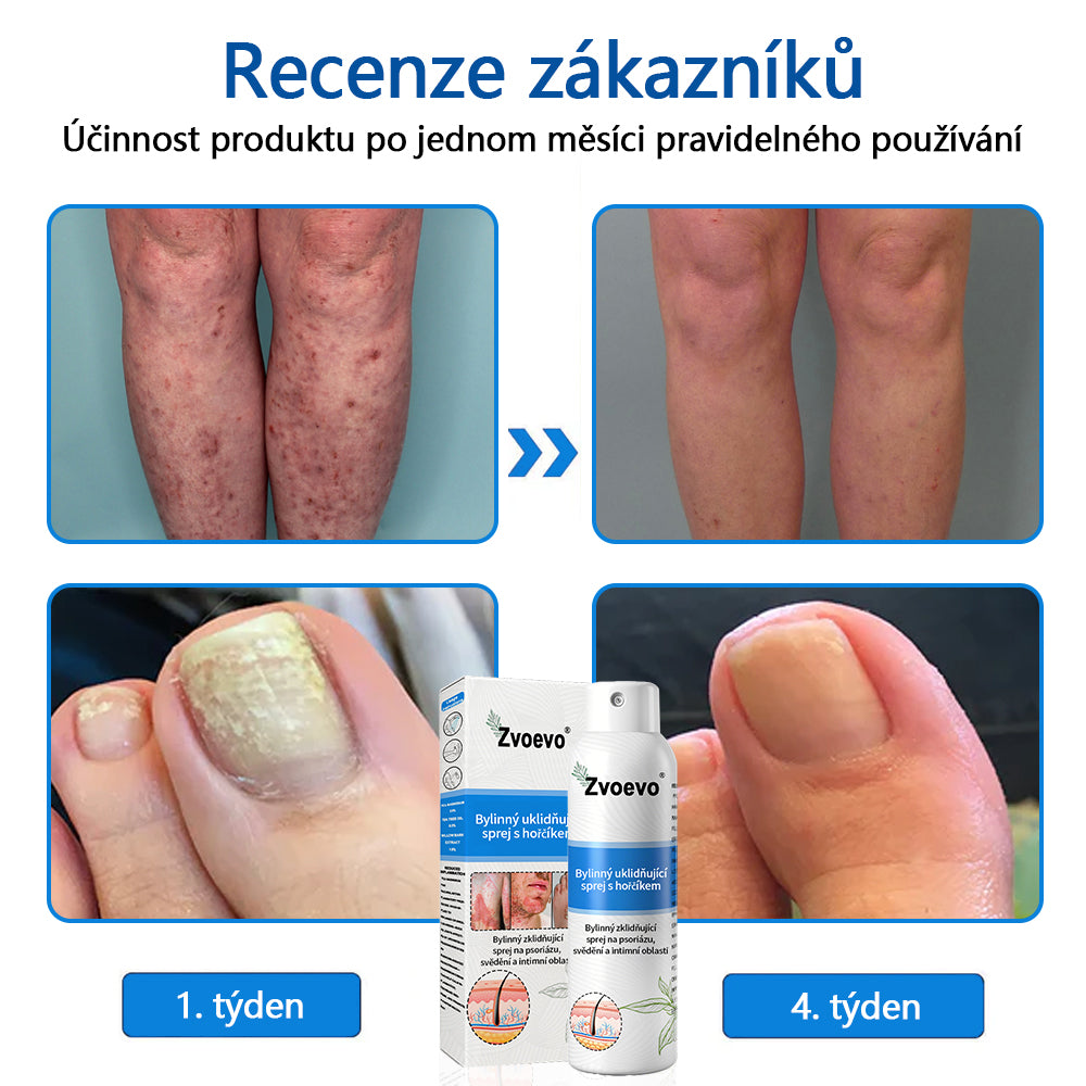 ✅Zvoevo® Magnesium bylinný sprej ⚕️ Certifikace MHRA – úleva při psoriáze, ekzému, intimních bakteriálních infekcích, akné a tmavých skvrnách