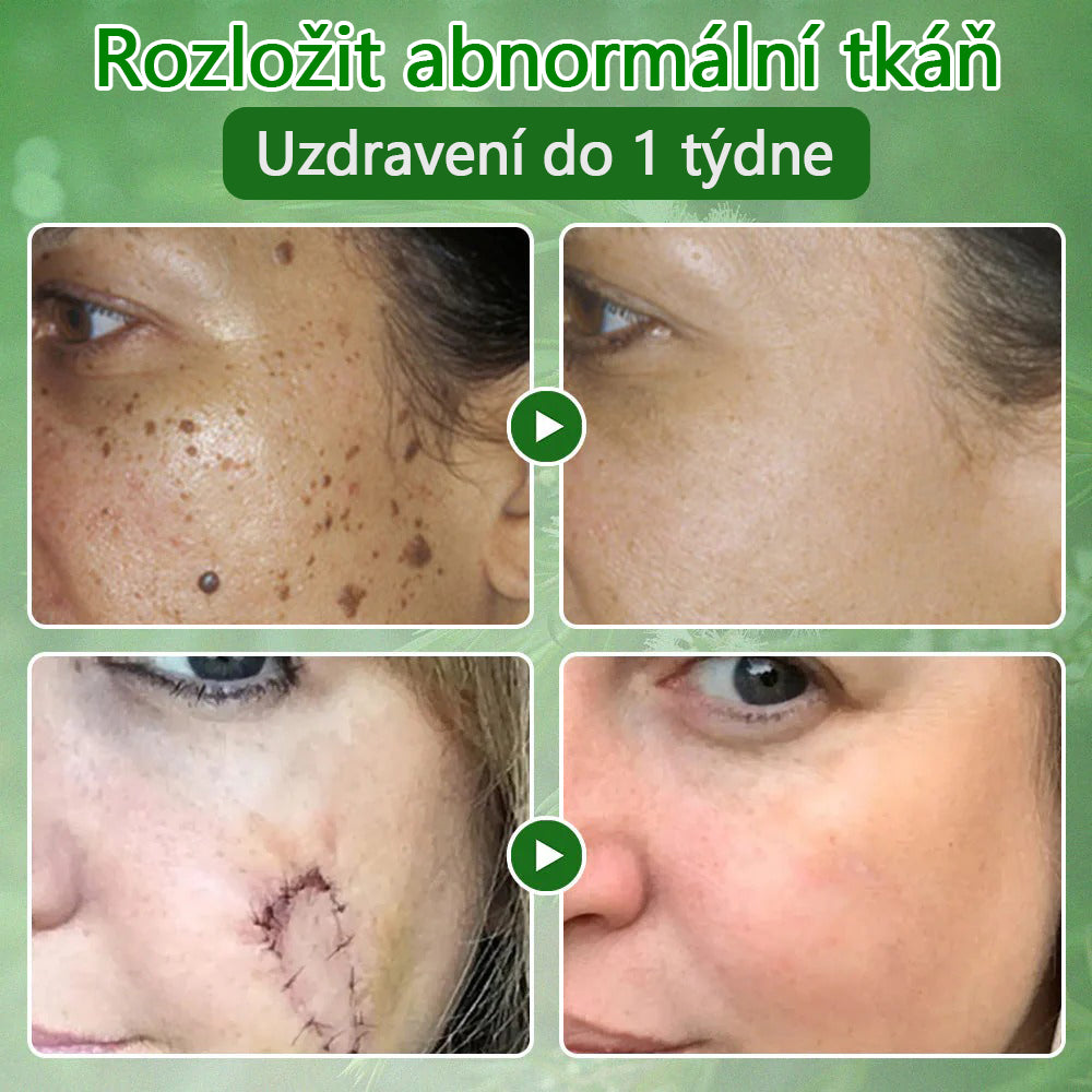 🌱 Zvoevo® Čajovníkový olej Krém pro péči o pleť – Odstraňuje nedokonalosti pleti, regeneruje poškozenou pokožku, rozjasňuje a působí proti stárnutí pleti.🔥🔥